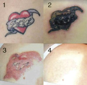 Get Rid Tattoo Review Get Rid Tattoo Review